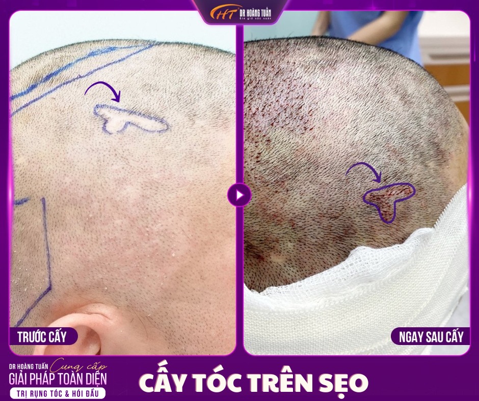 cấy t&oacute;c tr&ecirc;n sẹo